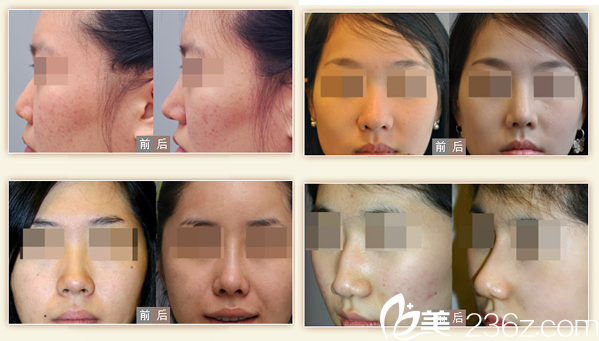 <!--<i data=20240703-sp></i>-->整形醫(yī)院自體耳軟骨隆鼻