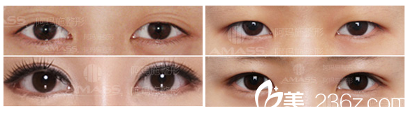<!--<i data=20240703-sp></i>-->整形醫(yī)院雙眼皮