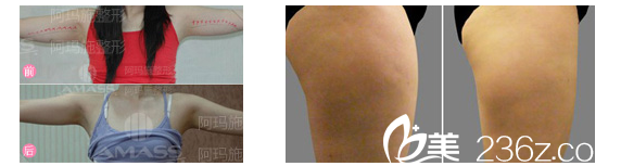 <!--<i data=20240703-sp></i>-->整形醫(yī)院手臂和大腿吸脂