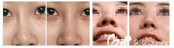 <!--<i data=20240703-sp></i>-->整形醫(yī)院隆鼻失敗修復(fù)