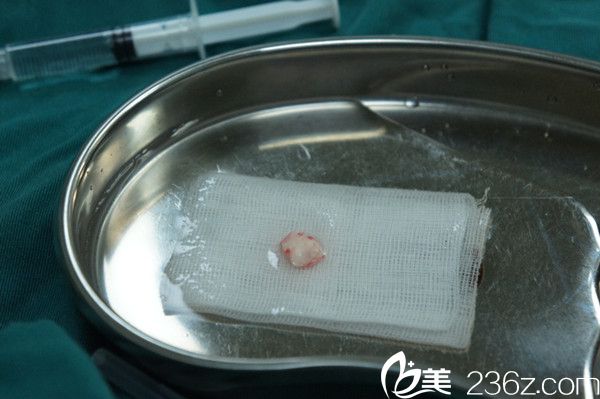 取耳軟骨墊鼻尖