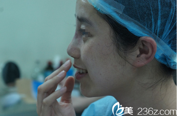 隆鼻術(shù)后即刻效果