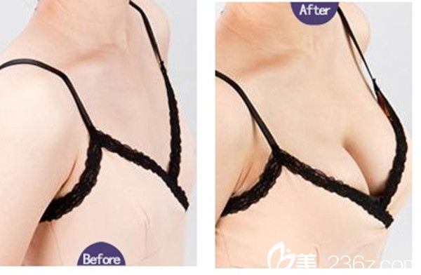 鄒琪隆胸手術(shù)真人案例