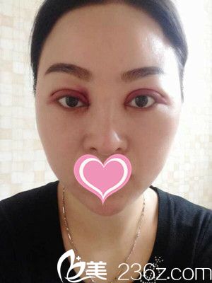 易軍學(xué)雙眼皮手術(shù)真人案例