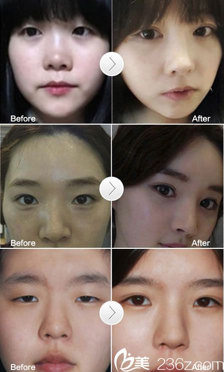 寧波尚麗整形雙眼皮案例 寧波尚麗整形雙眼皮案例