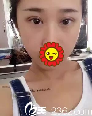 做雙眼皮手術(shù)第7天拆線的<span style=