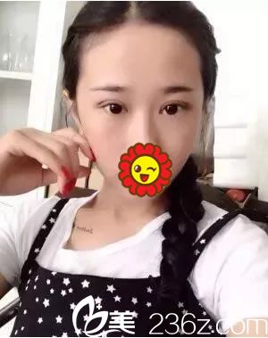 找徐建國(guó)割雙眼皮手術(shù)10天<span style=