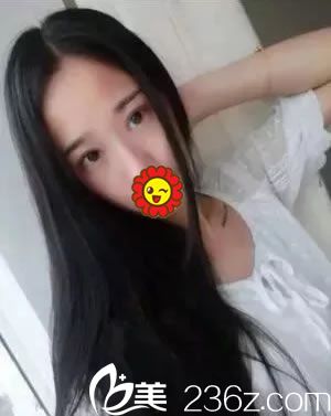 寧波建國(guó)整形做雙眼皮15天恢復(fù)照