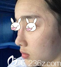 說我鼻子丑鞋拔子臉 索性在南陽(yáng)維多利亞做了隆鼻