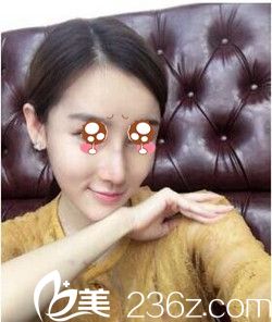 隆鼻術(shù)后7天