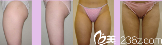 韓國Lilac BLC整形外科醫(yī)院案例 韓國Lilac BLC整形外科醫(yī)院案例