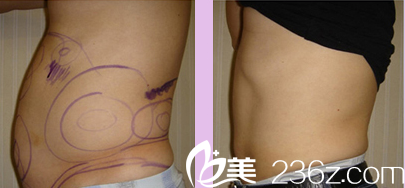 韓國(guó)Lilac BLC整形外科醫(yī)院案例 韓國(guó)Lilac BLC整形外科醫(yī)院案例