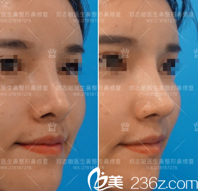 東莞美立方鄭志敏做的鼻綜合修復(fù)案例圖