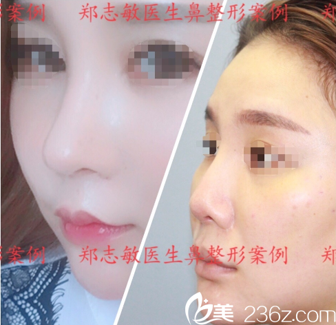 東莞美立方鄭志敏做的肋軟骨鼻綜合隆鼻子案例