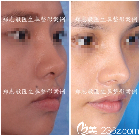 東莞美立方鄭志敏做的中隔軟骨鼻綜合隆鼻案例