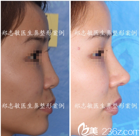 東莞美立方鄭志敏醫(yī)生肋軟骨鼻綜合隆鼻案例圖