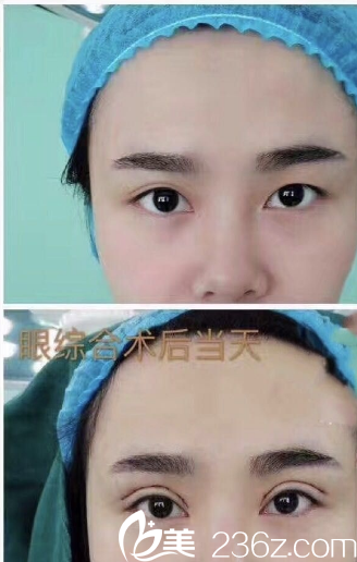 東莞美立方張克醫(yī)生做的雙眼皮眼綜合案例 東莞美立方張克醫(yī)生做的雙眼皮眼綜合案例