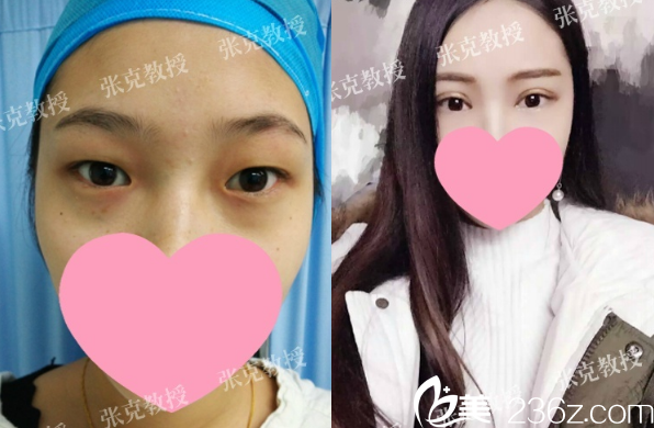 東莞美立方張克博士雙眼皮案例