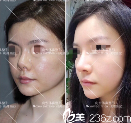 東莞美立方向宏偉醫(yī)生肋軟骨鼻修復(fù)案例