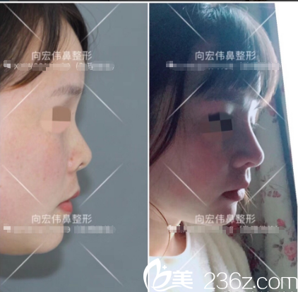 東莞美立方向宏偉醫(yī)生肋軟骨鼻綜合隆鼻案例