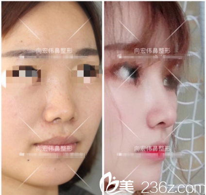 東莞美立方向宏偉醫(yī)生肋軟骨隆鼻案例效果圖片