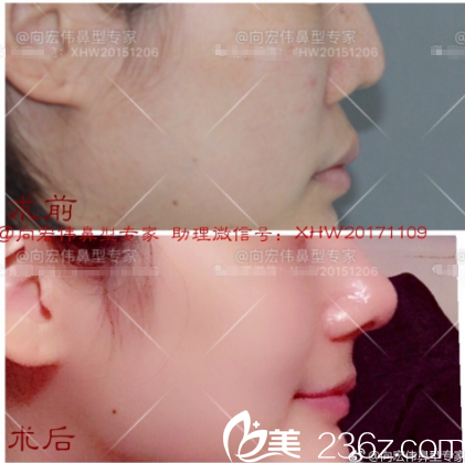 東莞美立方向宏偉醫(yī)生肋軟骨隆鼻案例