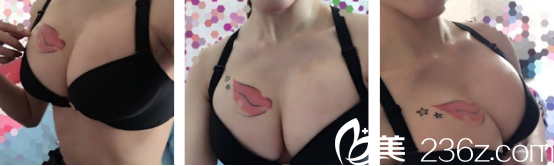 一天秤座妹子回憶在西安葉子醫(yī)院做的假體隆胸感受