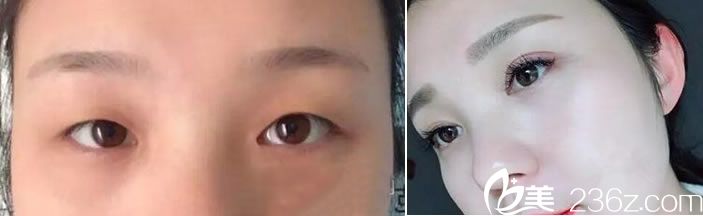 <!--<i data=20240703-sp></i>-->魏敬想醫(yī)生雙眼皮真人案例