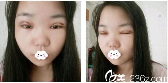 東莞美立方鄭志敏雙眼皮第二天