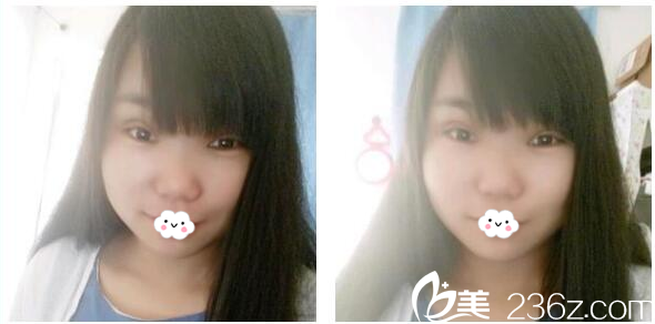 找東莞美立方鄭志敏做雙眼皮4天了