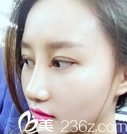 術(shù)后第七天樣子已經(jīng)有了