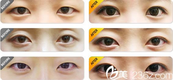 整形聶益軍雙眼皮案例 整形聶益軍雙眼皮案例