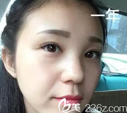 去年花5300元找做的雙眼皮和開眼角手術(shù)恢復(fù)效果還算滿意