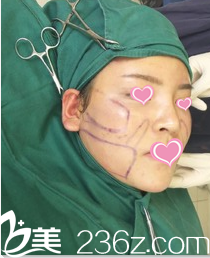 準(zhǔn)備面部吸脂時(shí)的照片