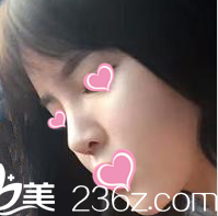 術(shù)后一個(gè)月的樣子