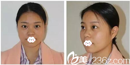 這是整形前的隆鼻和下巴特寫 這是整形前的隆鼻和下巴特寫