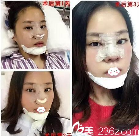 歐國(guó)升隆鼻和隆下巴術(shù)后天 歐國(guó)升隆鼻和隆下巴術(shù)后天