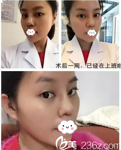 小雪隆鼻隆下巴術(shù)后一周恢復(fù)照片 小雪隆鼻隆下巴術(shù)后一周恢復(fù)照片