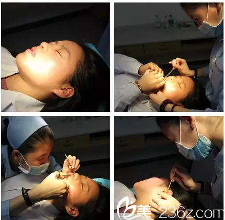 隆鼻8天小雪來(lái)江門華美拆線 隆鼻8天小雪來(lái)江門華美拆線