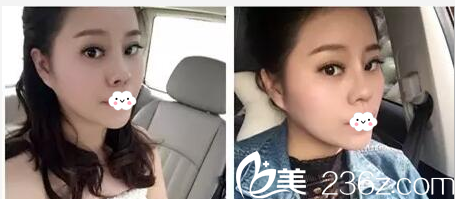 江門華美歐國(guó)升隆鼻隆下巴案例圖 江門華美歐國(guó)升隆鼻隆下巴案例圖