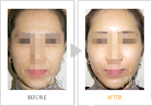 面部脂肪填充前后效果對比 面部脂肪填充前后效果對比