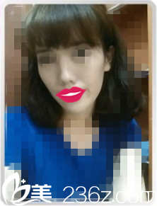 面部脂肪填充術(shù)前照 面部脂肪填充術(shù)前照