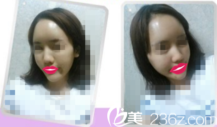 術(shù)后天 術(shù)后天