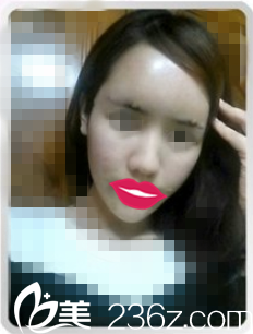 術(shù)后第三天效果 術(shù)后第三天效果