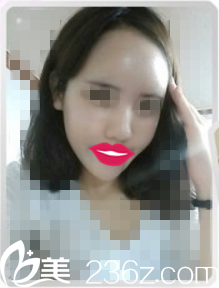 在韓國歐諾拉整形醫(yī)院做自體脂肪填充全臉才一個月，我媽說我看起來小了不止十歲！