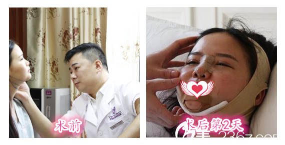 安徽維多利亞整形美容醫(yī)院徐和林給我做術(shù)前設(shè)計(jì)及術(shù)后第2天照片 安徽維多利亞整形美容醫(yī)院徐和林給我做術(shù)前設(shè)計(jì)及術(shù)后第2天照片