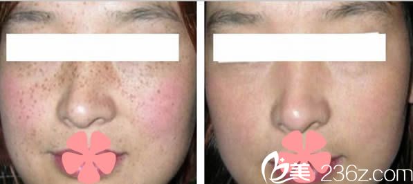 駱巧陽激光祛斑前后對比效果 駱巧陽激光祛斑前后對比效果