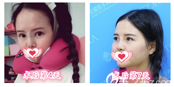 在安徽維多利亞做鼻綜合+眼綜合+下頜角整形術(shù)后第4天-第7天恢復(fù)過程圖展示 在安徽維多利亞做鼻綜合+眼綜合+下頜角整形術(shù)后第4天-第7天恢復(fù)過程圖展示