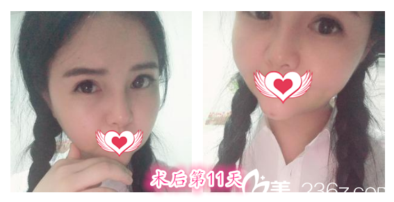 去安徽維多利亞整形外科醫(yī)院找徐和林做雙眼皮綜合整形+鼻綜合+下巴整形術(shù)后第11天恢復(fù)效果 去安徽維多利亞整形外科醫(yī)院找徐和林做雙眼皮綜合整形+鼻綜合+下巴整形術(shù)后第11天恢復(fù)效果