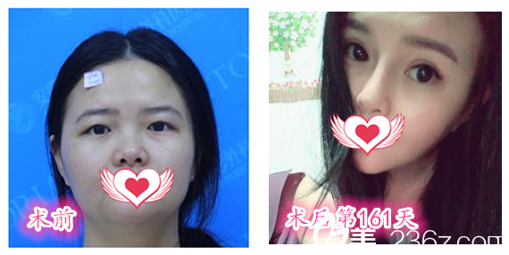 找安徽維多利亞整形美容醫(yī)院徐和林院長做全切雙眼皮眼綜合+硅膠隆鼻鼻綜合+下頜角整形前后對比圖 找安徽維多利亞整形美容醫(yī)院徐和林院長做全切雙眼皮眼綜合+硅膠隆鼻鼻綜合+下頜角整形前后對比圖